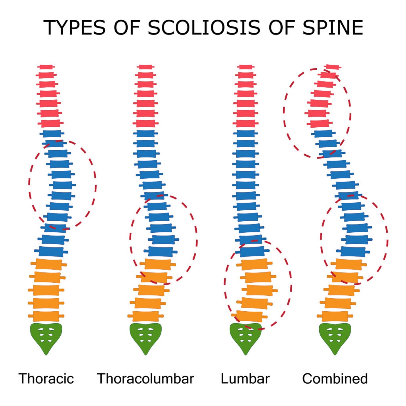 Chiropractic Therapy Treatment for Scoliosis